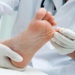 درمان میخچه با گوجه